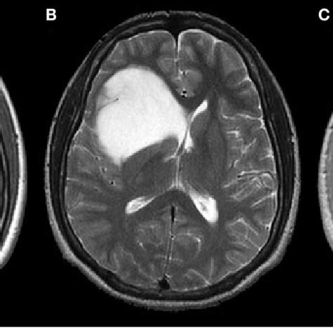 Functional MRI scan for preoperative planning. Rather than relying on ...