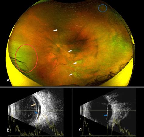 Long Term Follow Up Of Acute Retinal Necrosis With Retinal Detachment