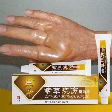 Antibacterial Blister Treatment Cream Immediate Pain & Relief Burn Cream for Minor Burns Sunburn ...