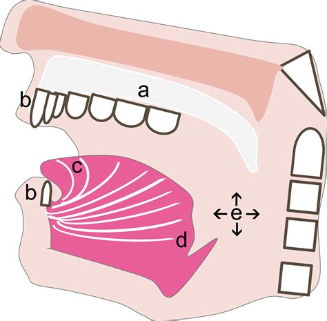 Congenital Oral Masses An Anatomic Approach To Diagnosis Radiographics