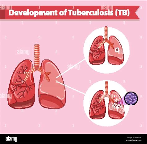 Scientific Medical Illustration Of Tuberculosis Illustration Stock