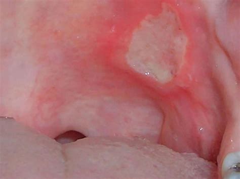 Crohn S Mouth Ulcers What To Know Mckee Dental Associates