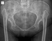 Developmental Dysplasia Of The Hip Adult