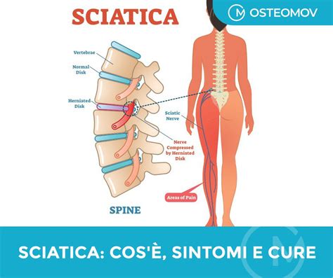 Sciatica Cos’è Sintomi E Cure Osteopata Roma Osteomov