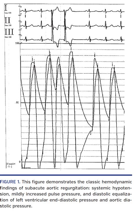 Hemodynamic Findings Of Severe Subacute Aortic Regurgitation