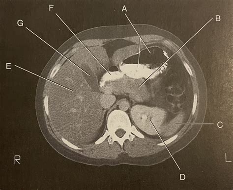 Abdomen Ct Diagram Quizlet