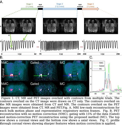 Pet Motion Correction Using Real Time Subspace Based Mr Imaging