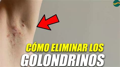 Cómo Curar Los Golondrinos De La Axilas Dile Adiós A La