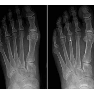 Preoperative and postoperative radiographs. After the metatarsal ...