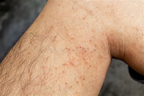 Dry Skin Rash On Lower Legs