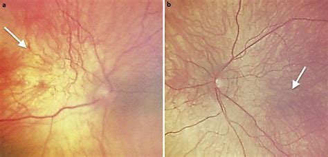 Fundus Photographs Of The Right Eye A And Left Eye B Showing