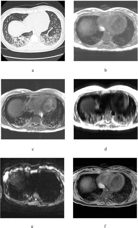 Chest Ct Scan And Mri Of 26 Year Old Woman A Axial Ct B T1wi