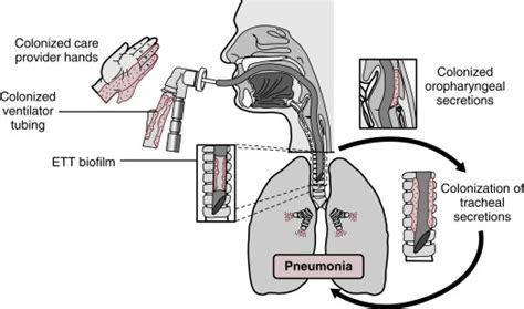 Ventilator Associated Pneumonia Pathophysiology