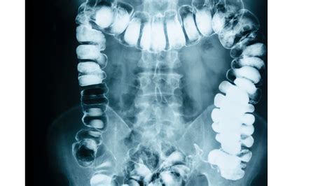 Intestinal Obstruction Symptoms Causes Treatment Preventions & More