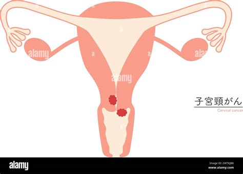 Diagrammatic Illustration Of Cervical Cancer Anatomy Of The Uterus And