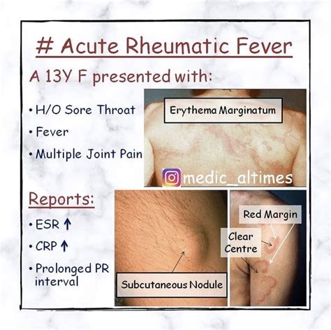 Acute Rheumatic Fever Medical Times