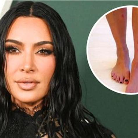 See Kim Kardashian’s Painful Psoriasis Flare Up On Her Legs