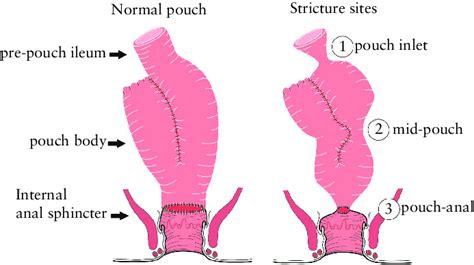 Salvage Surgery Effective Treatment Alternative For J Pouch Afferent