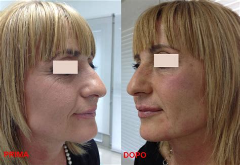 Tossina Botulinica Botox Dr Francesco Malatesta Chirurgia