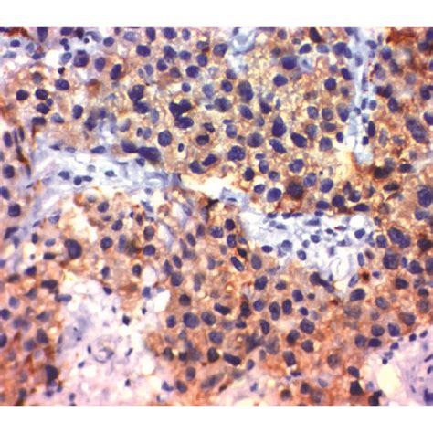 Immunohistochemical Staining Of Nedd9 In Transitional Cell Carcinoma