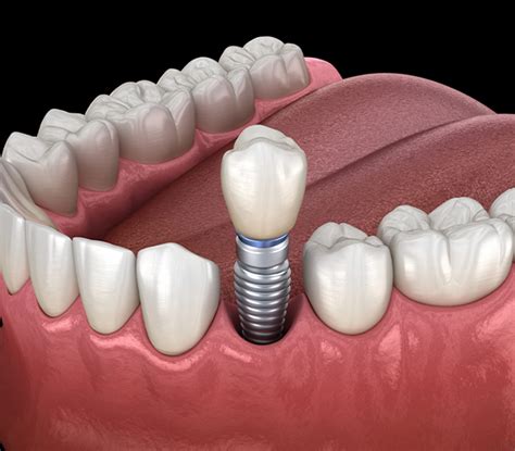 Dental Implants Woodland Dental