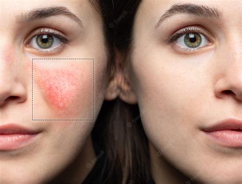 Treating Rosacea With Sciton Bbl Laser