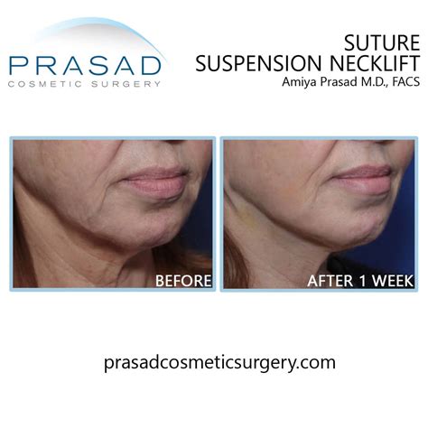 How to Choose the Best Neck Lift Procedure | Dr. Prasad Blog