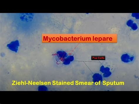 Mycobacterium Leprae Acid Fast