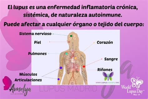 Qué es el lupus Asociación Lupus Madrid AMELyA