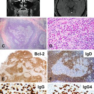 PDF Orbital Progressive Transformation Of Germinal Centers As Part Of