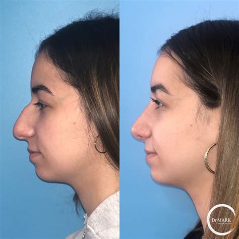 Rhinoplasty Before And After Images Dr Markarian