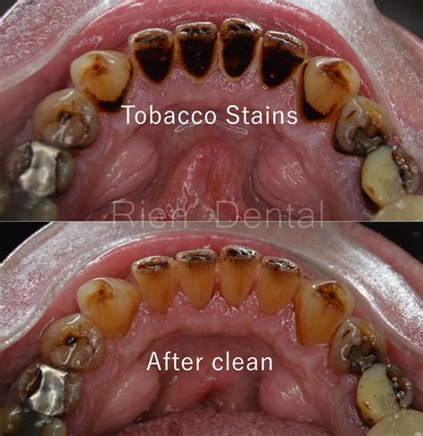 Tobacco Stains On Teeth