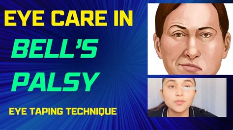 Eye Care Tips In Bells Palsy कैसे करें आंखों की सही देखभाल जानिए टिप्स Eye Taping Included