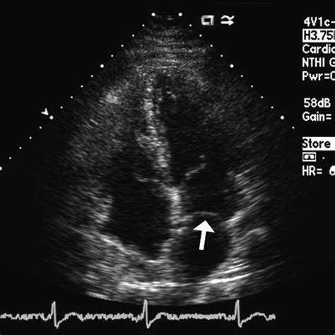 Transthoracic Echocardiography Showing Cor Triatriatum Arrow