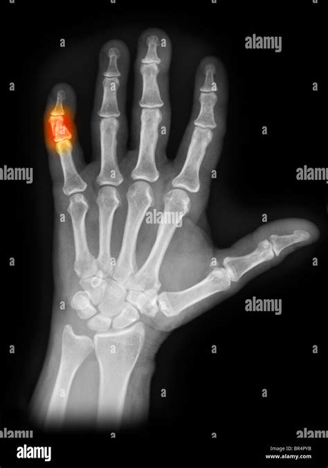 Colorized X Ray Of The Hand Showing A Fracture Of The 5th Finger Stock