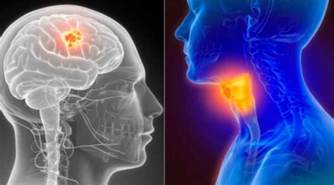 Nuevo Tratamiento Destruye Tumores Del C Ncer De Cabeza Y Cuello Seg N