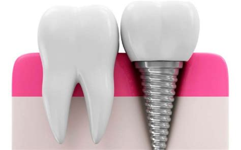 Que Es La Periimplantitis De Los Implantes Dentales Clinica Dental