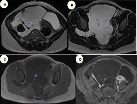 Abdominal And Pelvic MRI In Axial Sections T2 Sequence Without FATSAT