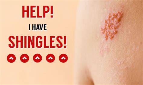 Help I Have Shingles U S Dermatology Partners