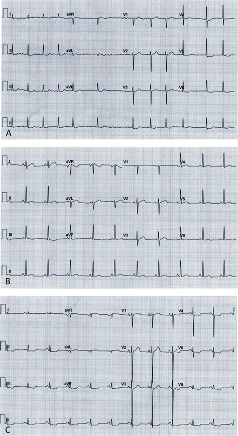 Electrocardiograms A Case Atrial Fibrillation St Segment