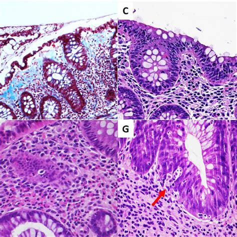 Non Ibd Colitis Non Infective Colitis A Collagenous Colitis The Download Scientific