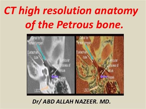 Presentation1.pptx, ct high resolution anatomy of the petrous bone.