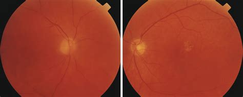 Cancer Associated Retinopathy Oncology Jama Ophthalmology Jama Network