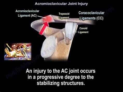 Acromioclavicular Joint Injury Ac Separation Everything You Need To