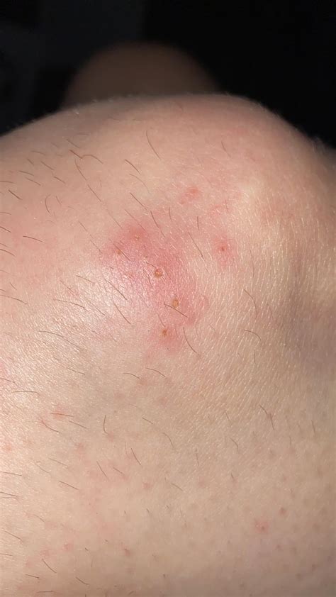 Is This a Yellow Sac Spider Bite? : r/medical_advice