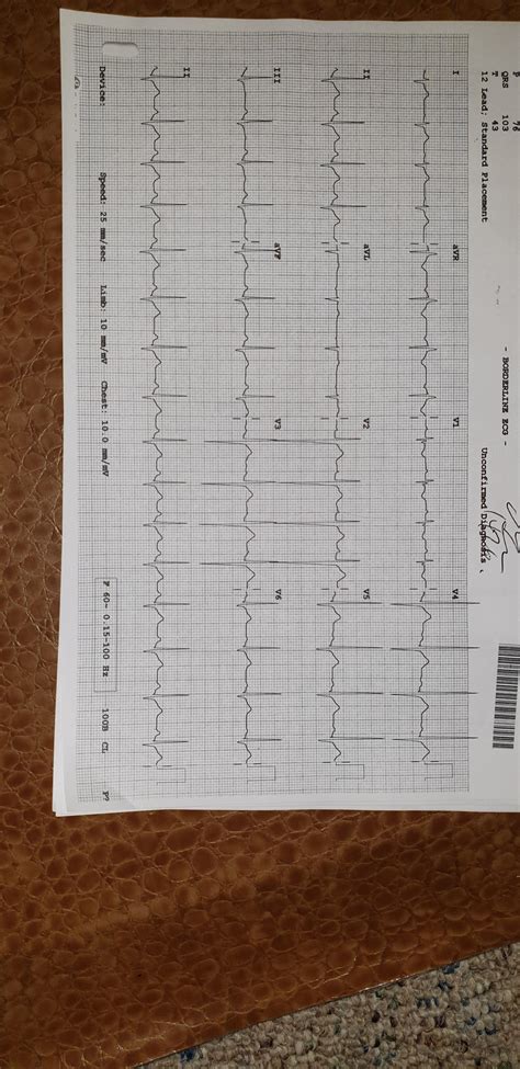 DOES THIS LOOK NORMAL? ESPECIALLY THE HUGE WAVES AT THE END? : r/EKG