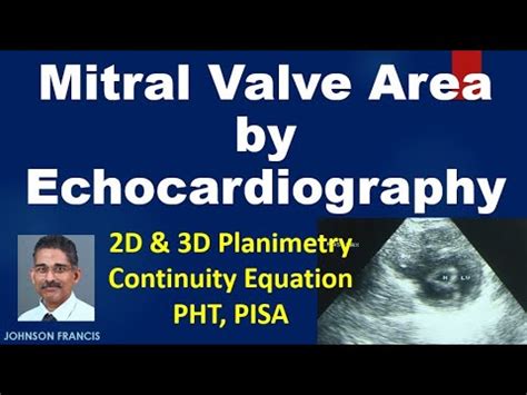 Assessment Of Mitral Valve Area By Echo D Planimetry Pht Pisa