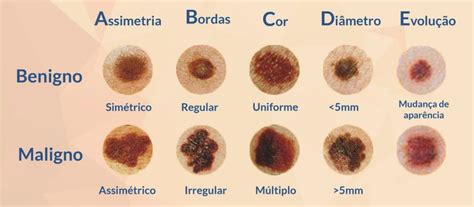 Pinta E Cancer De Pele