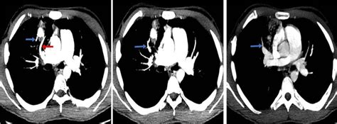 Ct Pulmonary Angiography Axial Images Sequence The Artery Of The