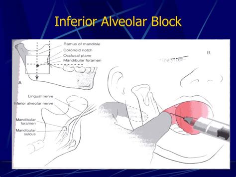 Inferior Alveolar Nerve Block Landmarks